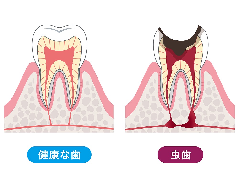 むし歯治療