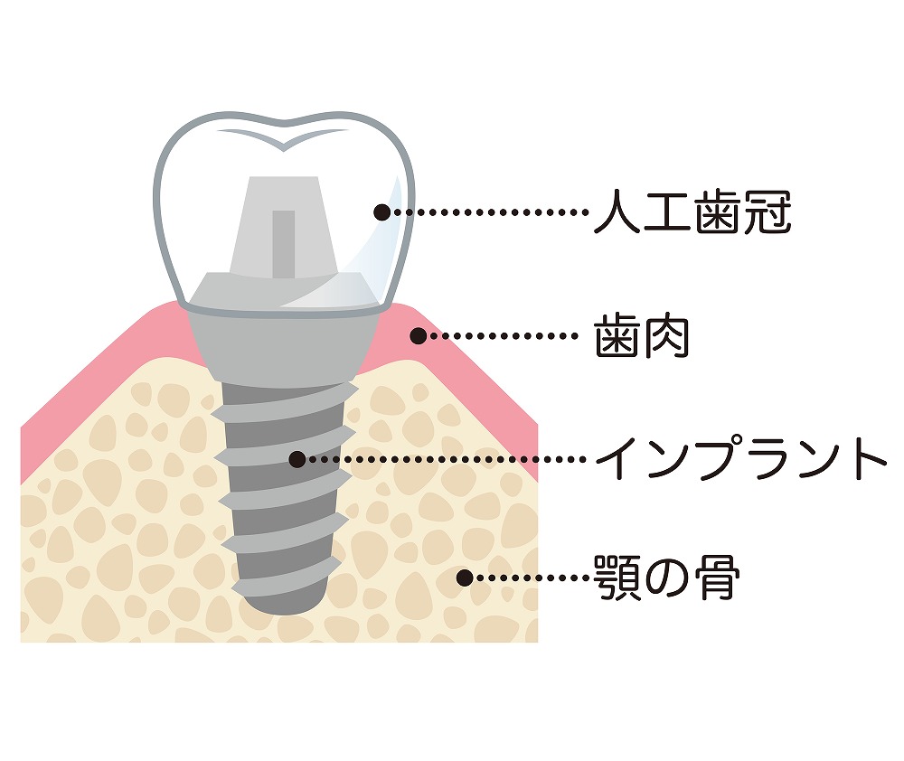 インプラントとは？