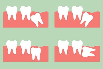 親知らずを抜歯した方がいい理由