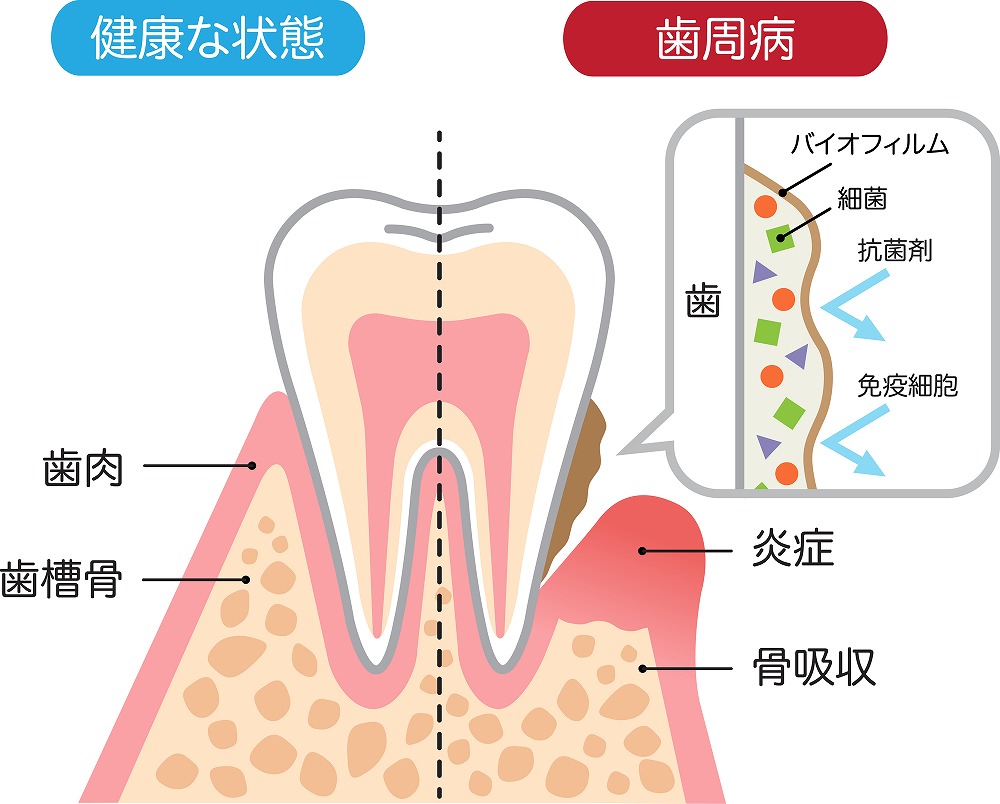 歯周病の原因