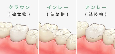 詰め物・被せ物について